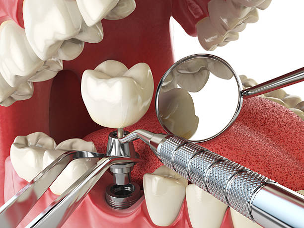 Best Emergency Denture Repair in Duluth, MN